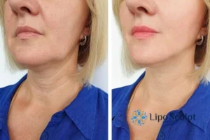 Double chin before and after Hi-Fu treatment 4 Book your double chin treatment Tetbury today! We are here to help!