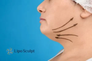 Double chin before and after Hi-Fu treatment 3 Boost your confidence with a Double chin treatment Tetbury