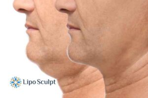 Double chin before and after Hi-Fu treatment 2 Double chin treatment Tetbury from Lipo Sculpt - feel more confident today!