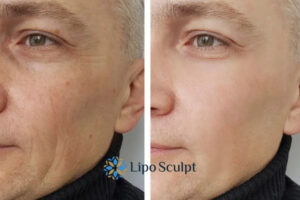 How to Fight Aging Symptoms 3 Fight Aging Symptoms Tetbury With HIFU and Morpheus8 Today!