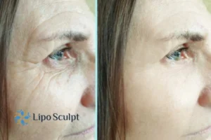 How to Fight Aging Symptoms 2 Do you want to Fight Aging Symptoms Tetbury? Contact Lipo Sculpt today!