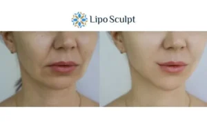 Explaining Total Skin Tightening Treatment And What It Can Do For You 2 Do you want to boost your self confidence? Give Morpheus8 Tetbury a try today!