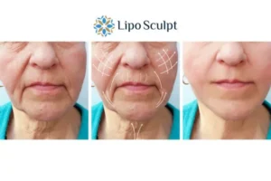 Explaining Total Skin Tightening Treatment And What It Can Do For You 3 Boost your confidence with Morpheus8 Tetbury call our team today!