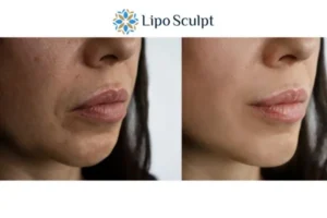 Explaining Total Skin Tightening Treatment And What It Can Do For You 4 Morpheus8 Tetbury the best results - call our team today!