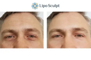 Explaining Total Skin Tightening Treatment And What It Can Do For You 6 Morpheus8 Tetbury book in today to find out more!