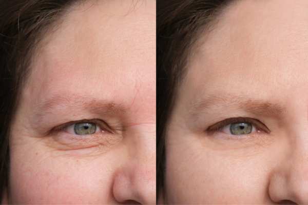 HIFU vs Botulinum Toxin: Understanding the Differences 4 How long do HIFU results last Tetbury?