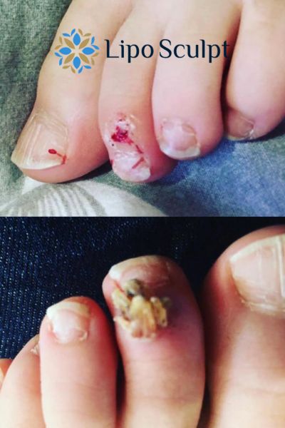 Wart removal customer results from Lipo Sculpt Tetbury