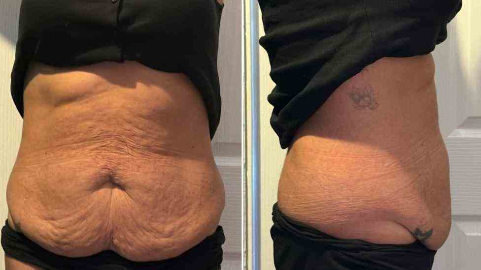 Lost the Weight but Not the Loose Skin? What You Should Know 1 Is It Definitely Loose Skin Tetbury?